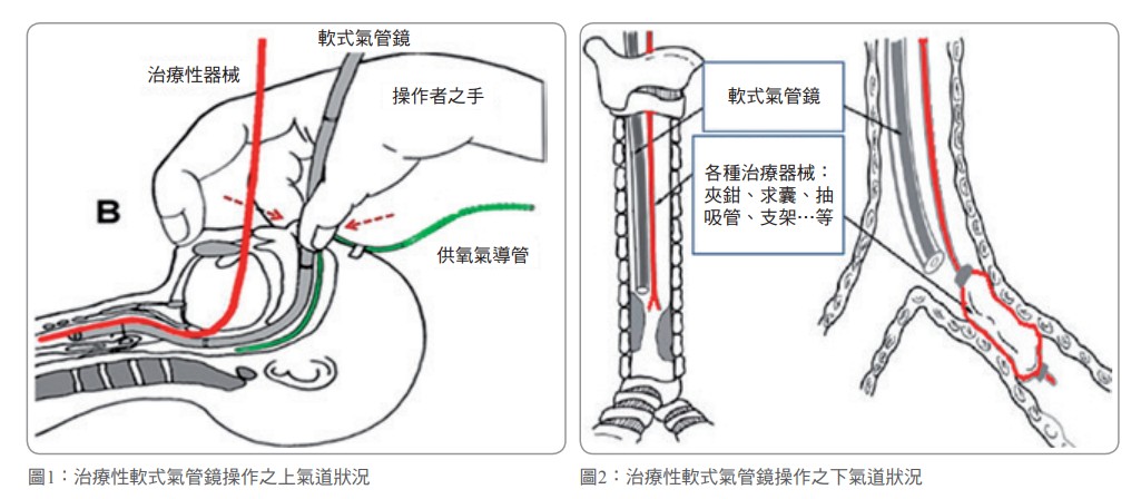 圖1：治療性軟式氣管鏡操作之上氣道狀況