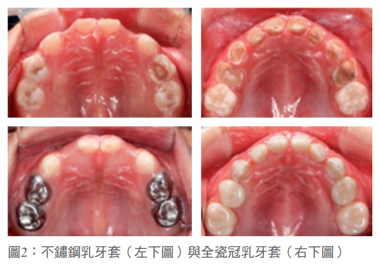 圖2：不鏽鋼乳牙套（左下圖）與全瓷冠乳牙套（右下圖）