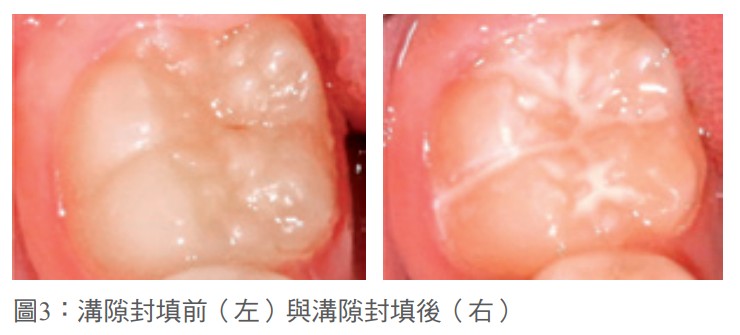 圖3：溝隙封填前（左）與溝隙封填後（右） 