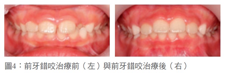 圖4：前牙錯咬治療前（左）與前牙錯咬治療後（右） 