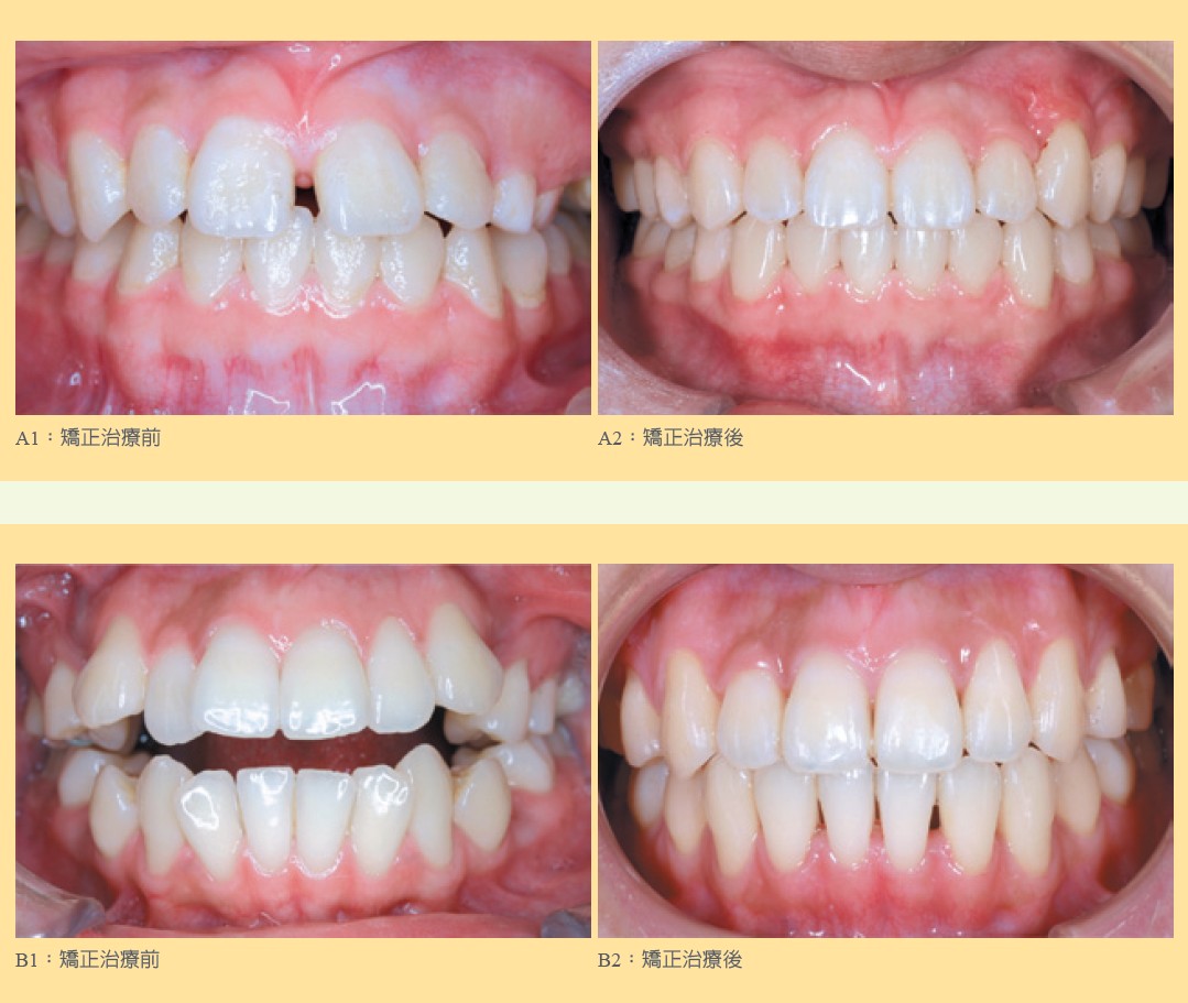 牙齒矯正治療
