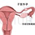 腹腔鏡子宮外孕手術