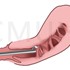 經子宮頸子宮内視鏡子宮腔沾粘分離手術