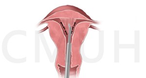 經子宮頸子宮内視鏡子宮中隔切除手術
