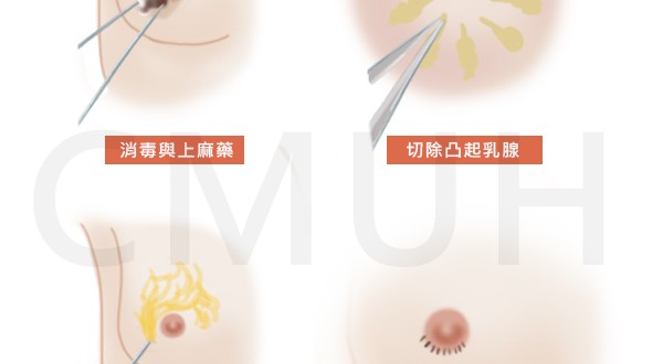 男性女乳手術