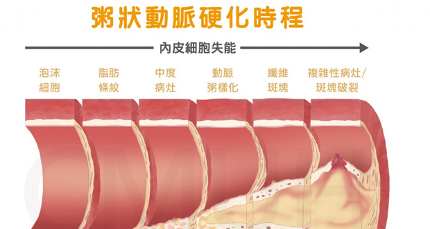 粥狀動脈硬化時程