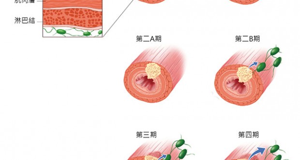 食道癌