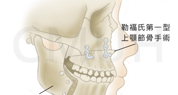 正顎手術