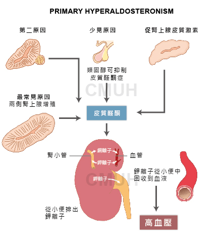 原發性皮質醛酮過多症