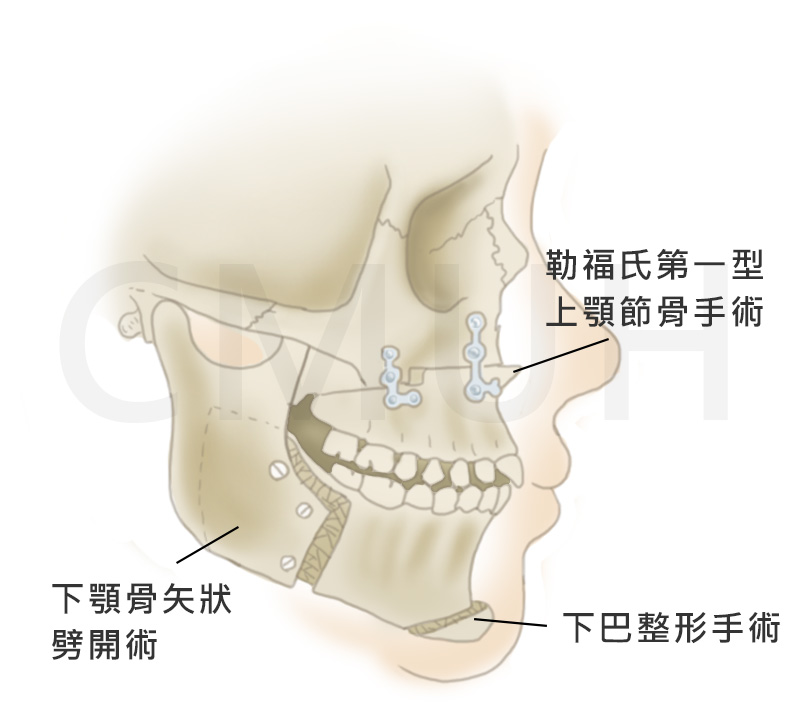 正顎手術