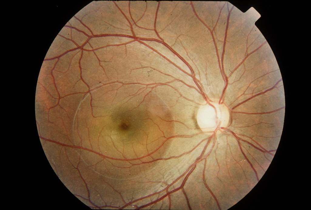 中心性漿液性視網膜病變
