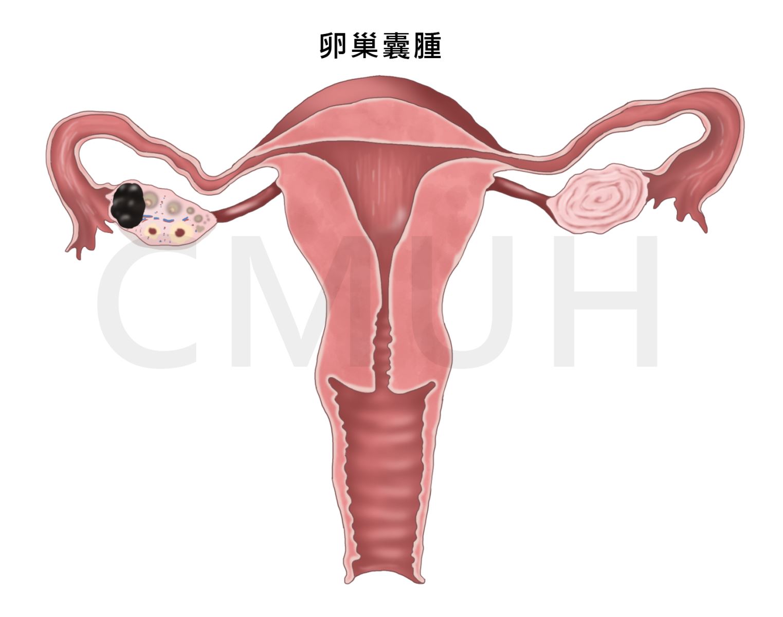 卵巢囊腫是充滿液體的囊袋在卵巢內或在卵巢的表面。