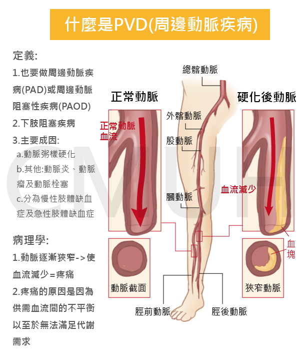 下肢周邊動脈阻塞性疾病