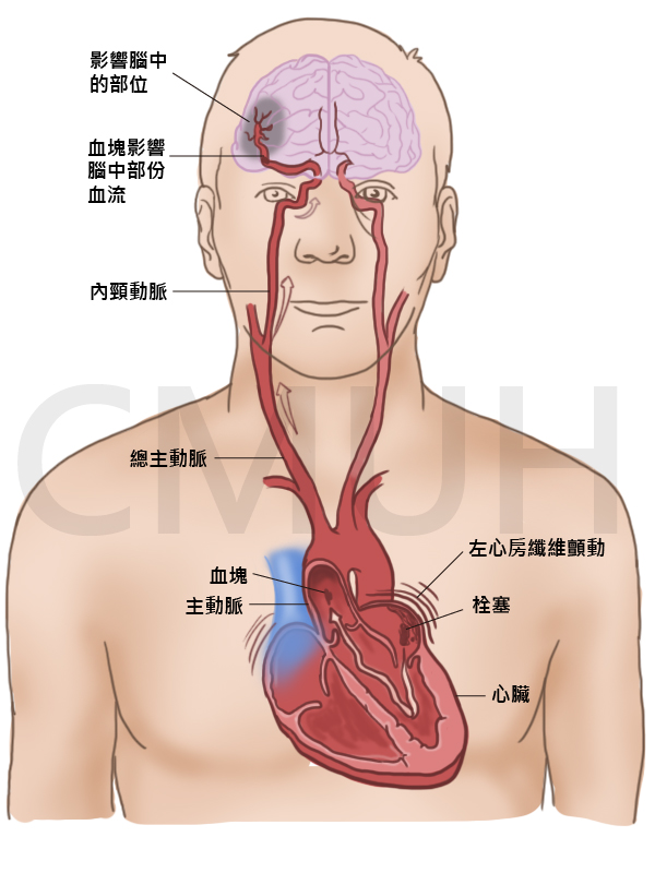 心房顫動