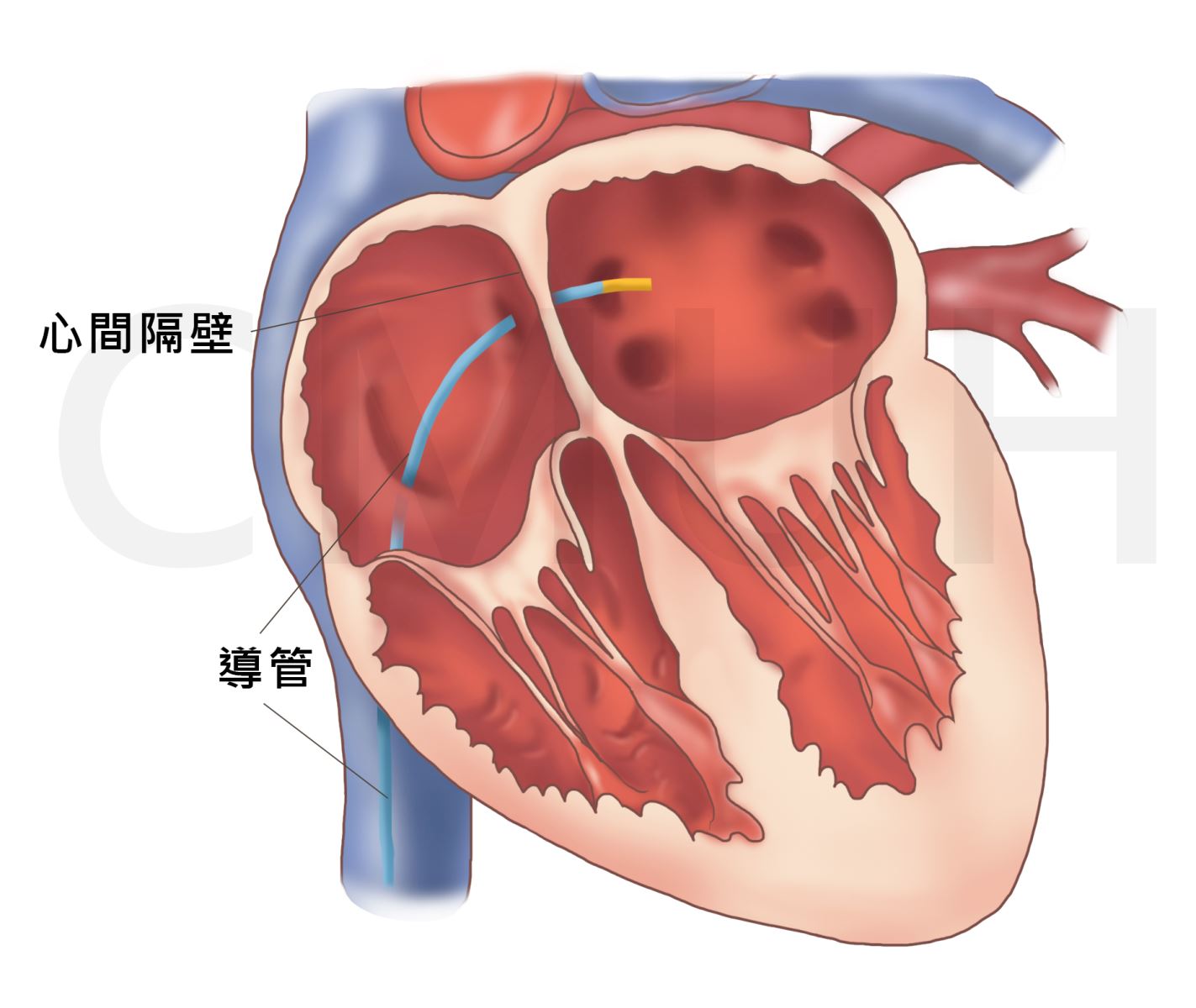 心房顫動