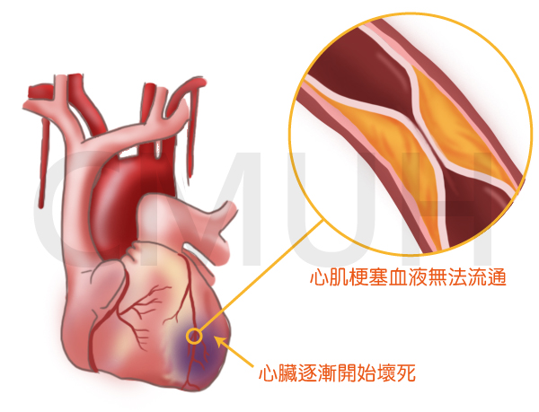 心絞痛與心肌梗塞症狀之差異