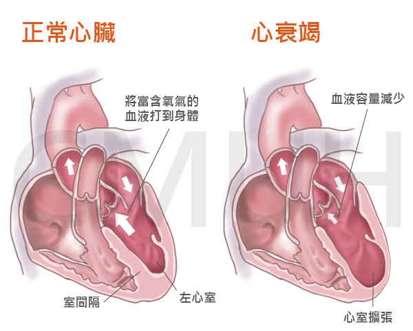 心衰竭