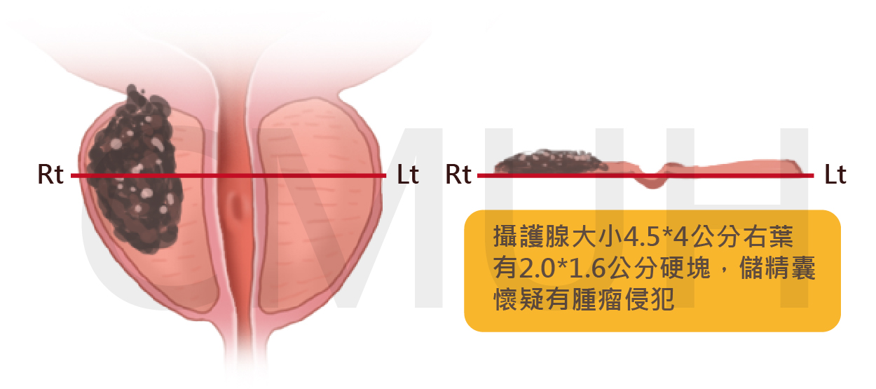 攝護腺癌