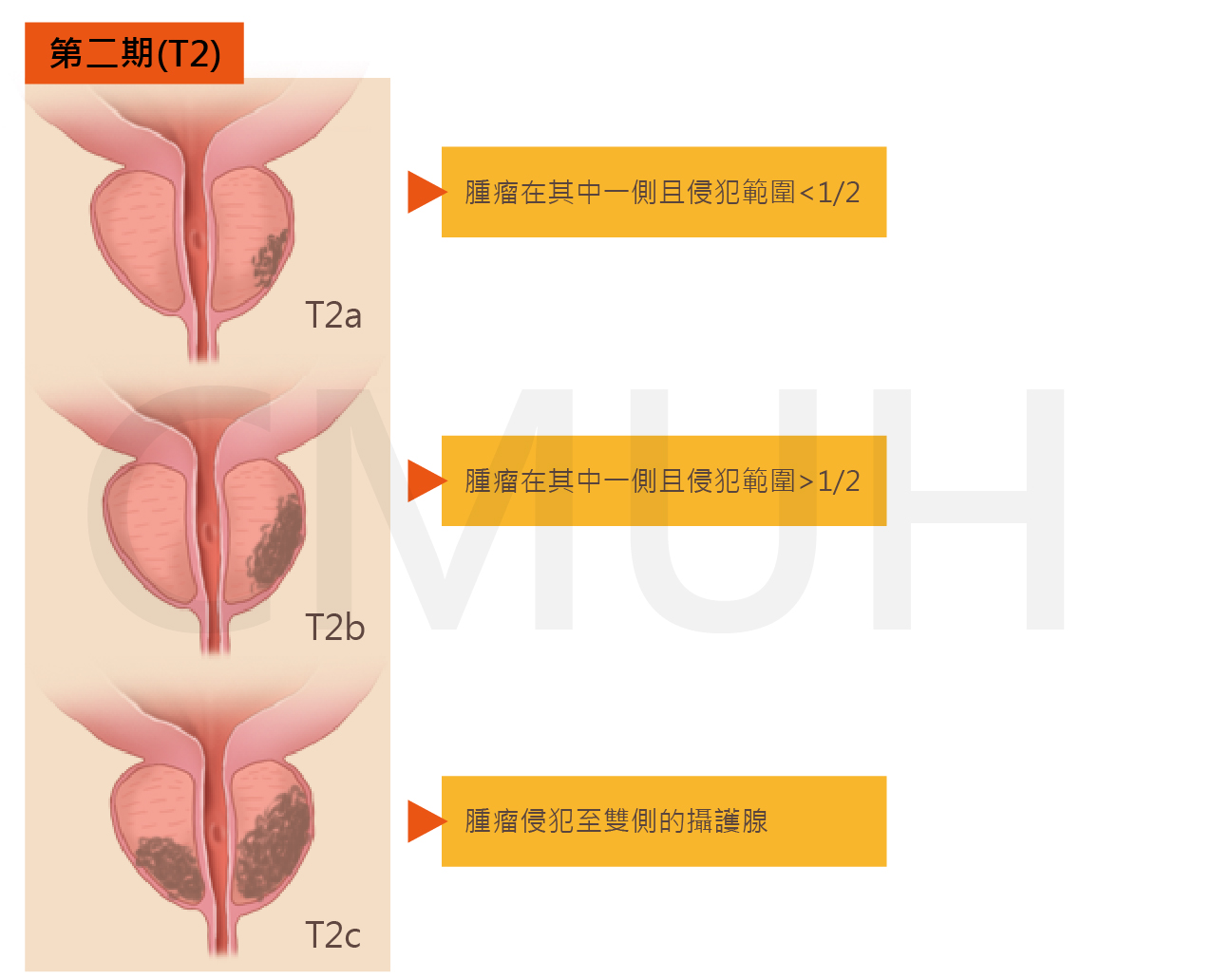 攝護腺癌