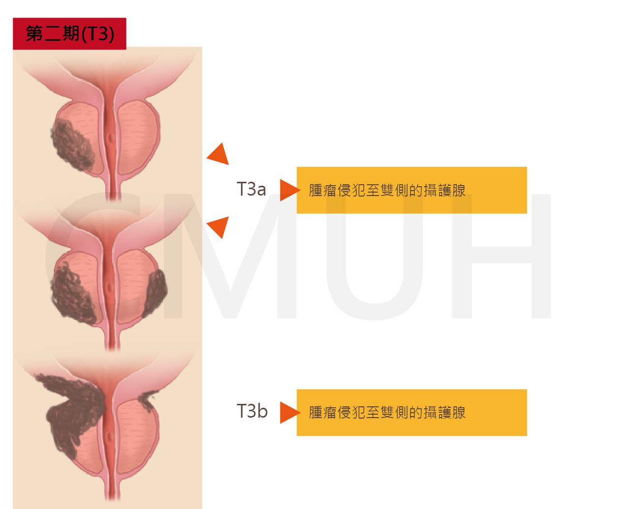 攝護腺癌