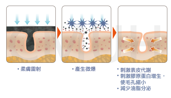 銣雅鉻雷射除斑