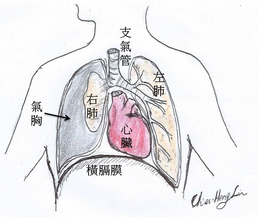 氣胸