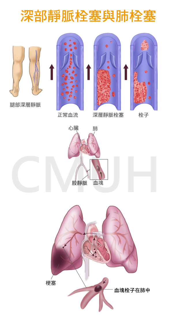 深層靜脈栓塞