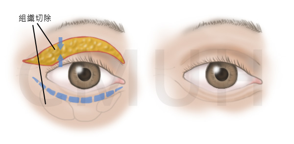 雙眼皮手術