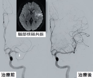 缺血性腦中風患者施行經腦動脈血栓去除術後對照圖