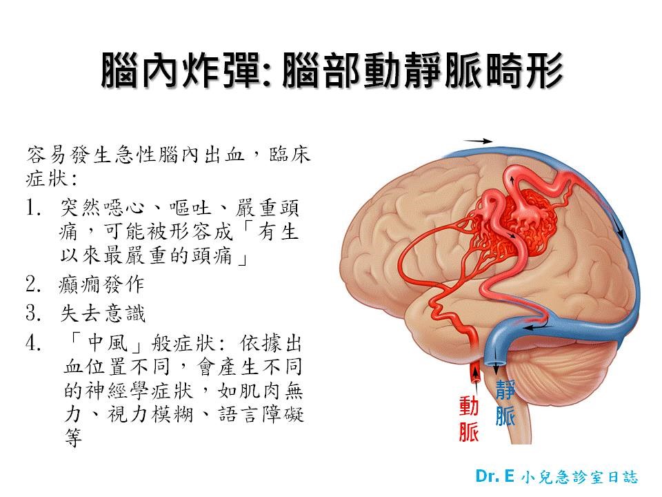 腦部動靜脈畸形