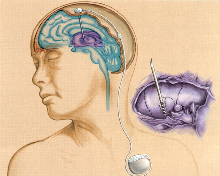 腦晶片刺激治療法可使顫抖症狀顯著改善