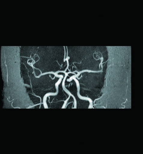 腦部核磁共振的腦血管組像