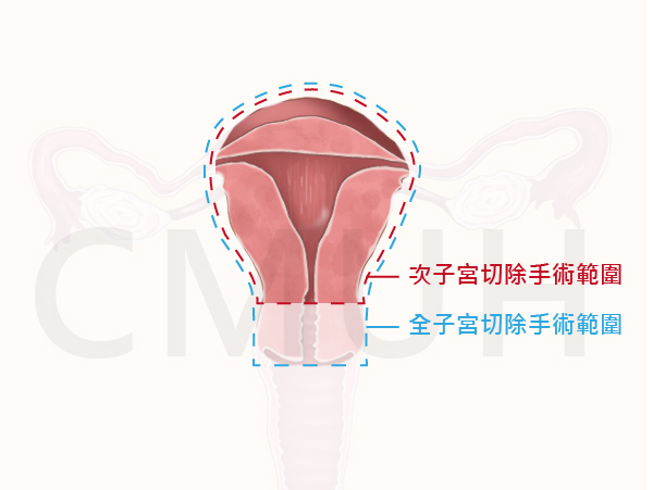 子宮切除手術