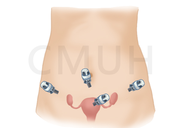 腹腔鏡全子宮切除手術