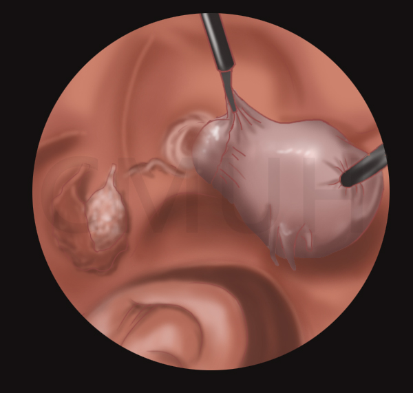 腹腔鏡全子宮切除手術
