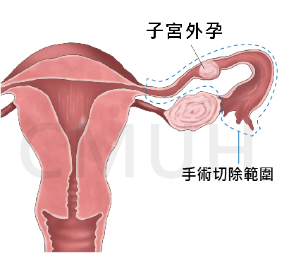 輸卵管切除術