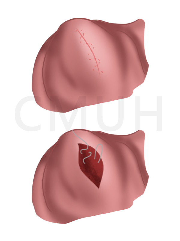 腹腔鏡子宮肌瘤切除手術