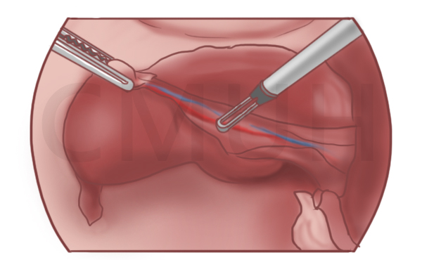 子宮與韌帶和血管分離