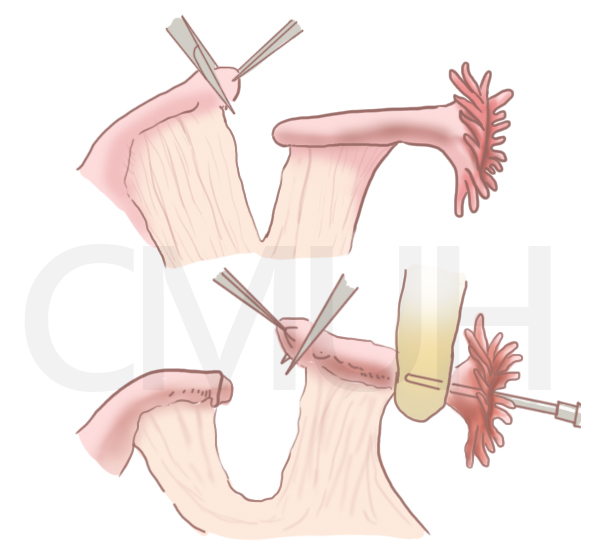 腹腔鏡輸卵管重建手術