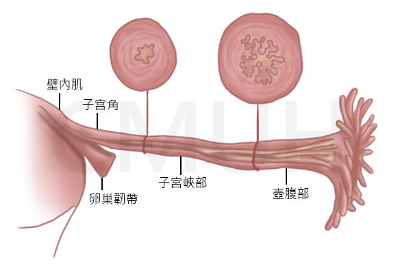 腹腔鏡輸卵管重建手術