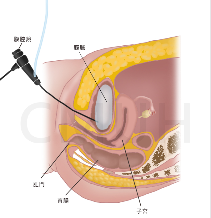 膀胱鏡