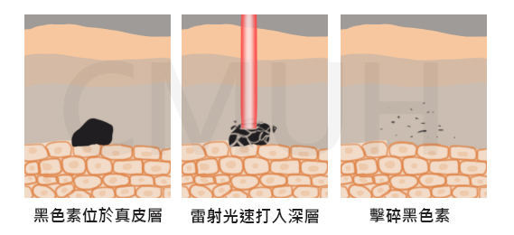 銣雅鉻雷射除斑