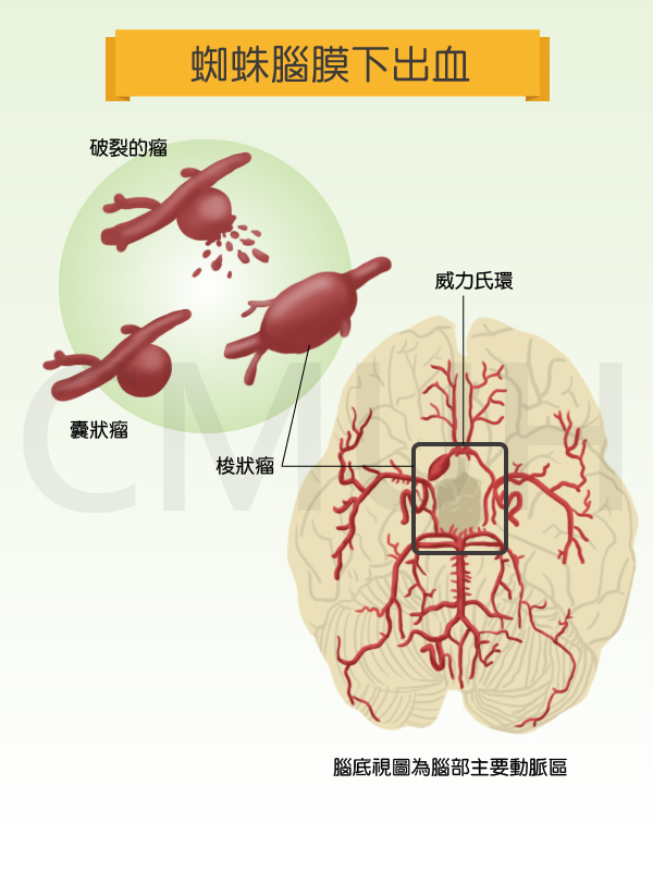 蜘蛛膜下腔出血