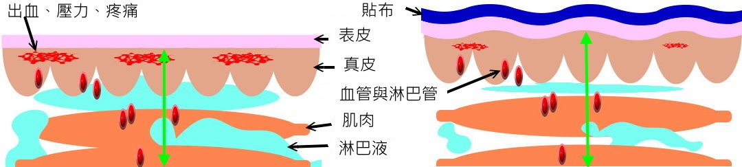 貼紮術