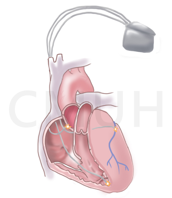 雙心室再同步心律調節器