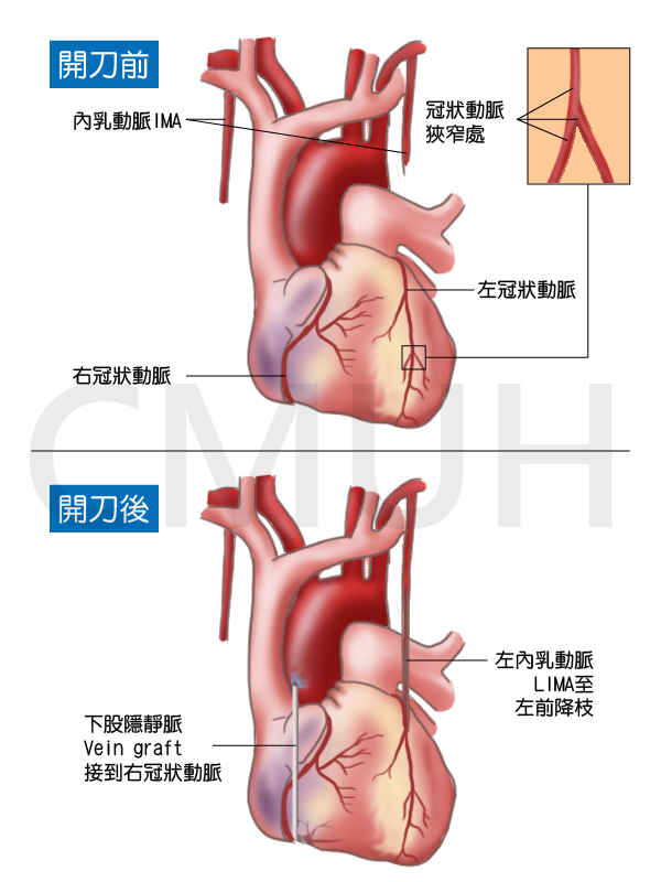 冠狀動脈繞道手術