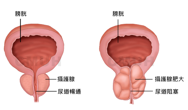 血尿 射精 後