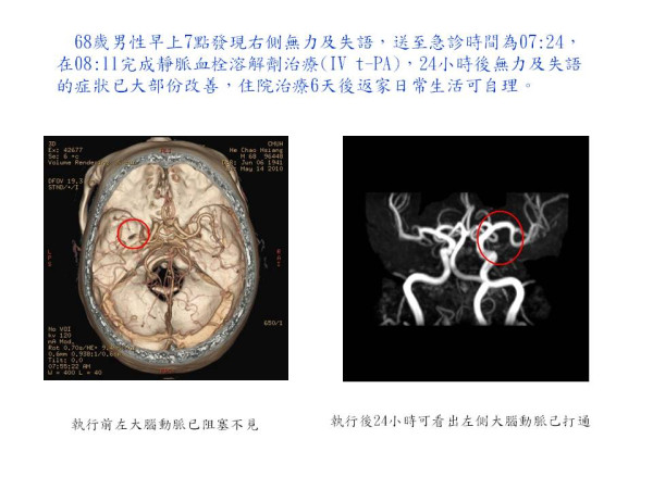 靜脈血栓溶解劑治療 案例1