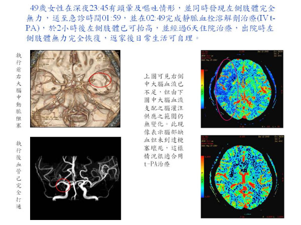 靜脈血栓溶解劑治療 案例2