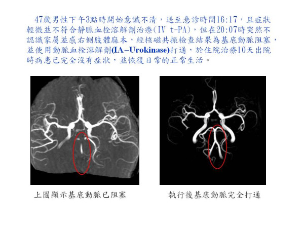 動脈血栓溶解劑治療 案例1